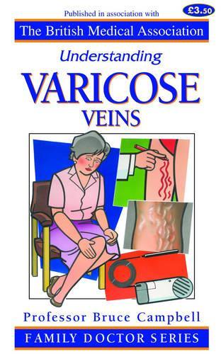 Understanding Varicose Veins (Family Doctor Series)
